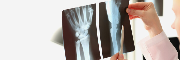 female doctor looks at x-ray of a arm injury in hospital. Sequelae of hand injuries and arthritis