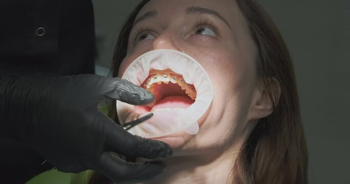 Orthodontist in black medical gloves presses the teeth of patient with braces. Process of removing braces.