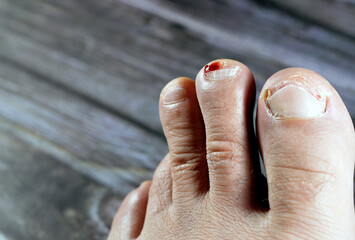 Bleeding on the tip of the second toe of the left foot, insult of the foot toe resulting in a...