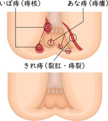 肛門　痔　イラスト