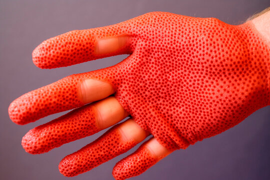 Latex allergy: Visual representation of a person wearing non-latex gloves or showing symptoms like rash or itching after contact with latex Generative AI