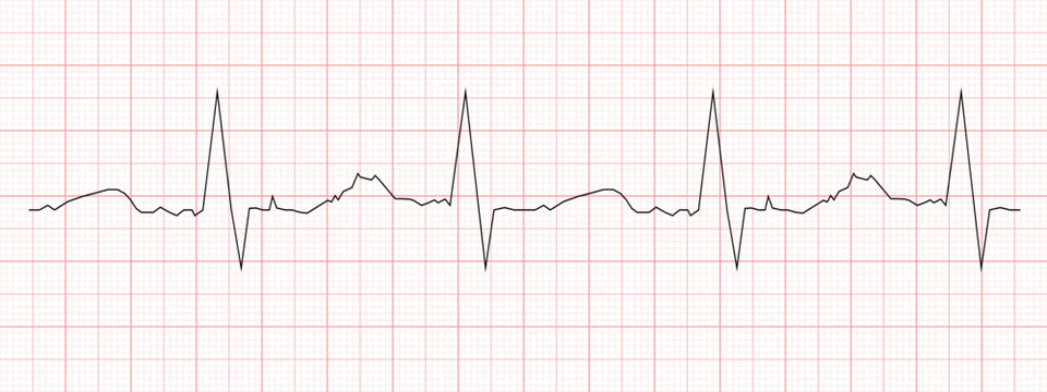 Black heart beat diagram printed on red graph paper. ECG chart. Cardiac rhythm line. Cardio test sign. Cardiology hospital symbol
