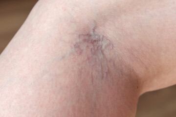 Fototapeta premium Varicose veins on a leg, close-up