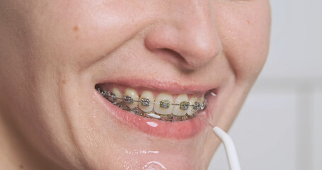 Jet of water from dental irrigator cleans female teeth with metal braces. Close-up mouth. Dental care concept, daily routine, orthodontist advice