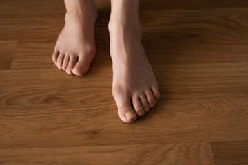 Hallux valgus on female legs on the background of laminate flooring. A bump on a woman's legs...