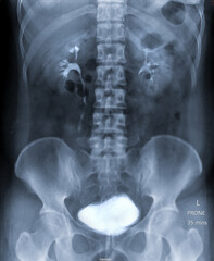  Intravenous pyelogram or I.V.P is an X-ray exam of urinary tract after injection contrast media agent  .