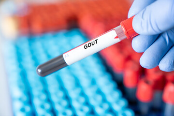 Fototapeta premium Gout. Gout disease blood test in doctor hand