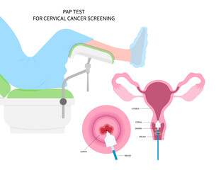 Diagnostic procedure for cervix cancer of women female and vulvar warts obstetric swab cytology by cervical pap smear test the HPV with loop excision or LEEP examine sex cell cone prevent screen care - obrazy, fototapety, plakaty