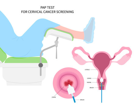 Diagnostic procedure for cervix cancer of women female and vulvar warts obstetric swab cytology by cervical pap smear test the HPV with loop excision or LEEP examine sex cell cone prevent screen care
