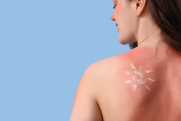 Allergic young woman with sunburned skin and sun made of cream on blue background, back view