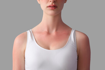 Allergic young woman with sunburned skin on grey background, closeup