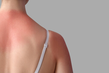 Allergic young woman with sunburned skin on grey background, back view