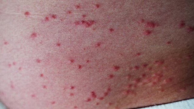Skin rash - Pimples on the skin, Summertime Rashes. Possible insect bites, allergic reaction. Severe itching. Macro.
