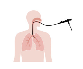 Bronchoscopy procedure concept