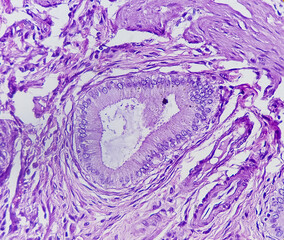 Chronic cholecystitis of Gallbladder, show perimuscular fibrosis and infiltration of chronic...