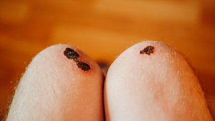 Close up bleeding scratches knees, bruises on the skin, close up injury hurt dried blood, suffering...