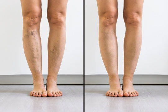 Person Leg With Varicose Veins And Capillaries Before