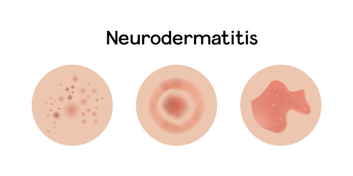 รูปภาพNeurodermatitis – เลือกดูภาพถ่ายสต็อก เวกเตอร์ และวิดีโอ768 ...