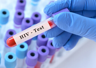 Obraz premium Doctor's hand holds test tube in blood on the background of test tubes with analyzes.Blood sample with HIV testing