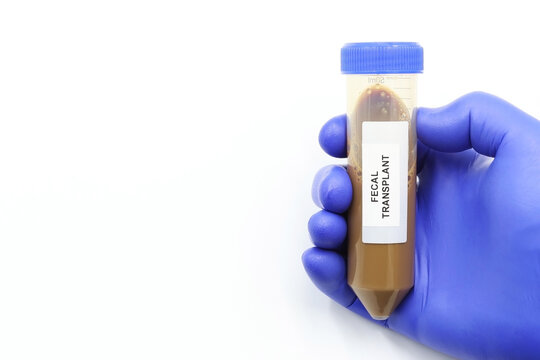 Fecal transplant or fecal matter transplant (FMT). A laboratory tube with with fecal microbiota to cure persistent digestive diseases such as infection by Clostridium bacteria