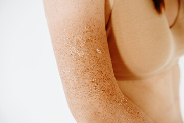 Peeling skin after sunburn, dermatology problems at woman hand and shoulder, flaking skin and...