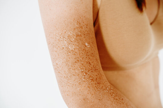 Peeling skin after sunburn, dermatology problems at woman hand and shoulder, flaking skin and skincare concept, sensitive skin.
