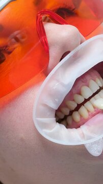 classical dental coloring for determining color of teeth dental clinic using optragate mouth dilator woman getting teeth color matched after whitening close-up face 