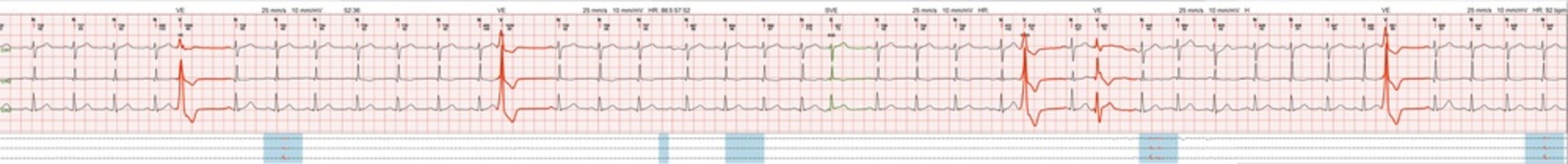 Electrocardiography ECG test patient with charts scientific cardiograms from heart wave, graph on paper