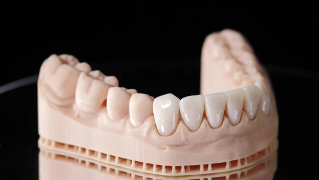 Veneers for teeth on jaw model. Shot on black background. Artificial teeth. Ceramic dentures and crowns. Zirconium crown. Dental and teethcare care. installing veneers. Dental veneer placement