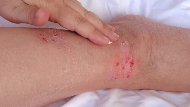 wound on painful female leg, heals with medicine, person treats with ointment, cream, Self-care practices, Dermatological disorders, wound healing process, Wound care and treatment