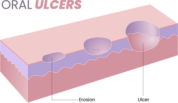 illustration of oral ulcer diagram