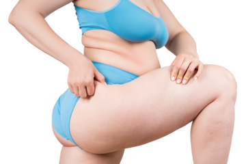 Overweight woman, fat thighs and buttocks, obesity female legs with cellulite