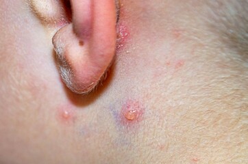 Fototapeta premium Varicella virus or Chickenpox bubble rash on child