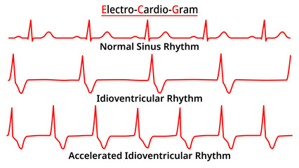 Set of ECG Common Abnormalities - Idioventricular Rhythm vs Accelerated (AIVR) - Normal Sinus Rhythm - Electrocardiography Vector Medical Illustration