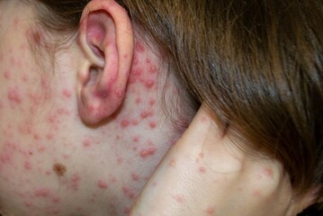 Varicella virus or Chickenpox bubble rash on child - obrazy, fototapety, plakaty