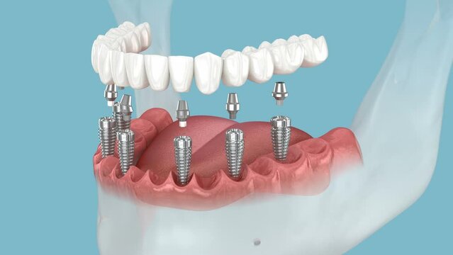 Mandibular prosthesis fixation over six implants. Medically accurate 3D animation