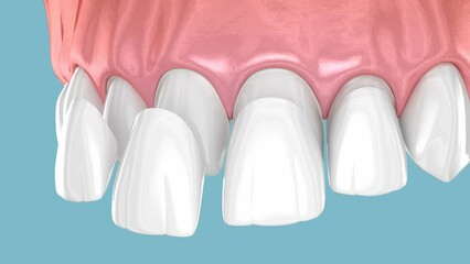 Dental veneer placement over central and lateral incisor. 3D animation