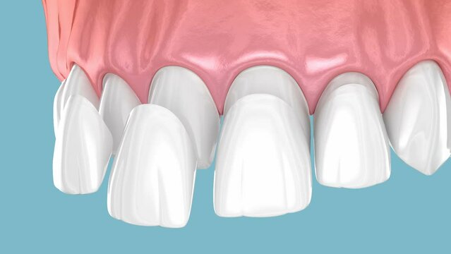 Dental veneer placement over central and lateral incisor. 3D animation