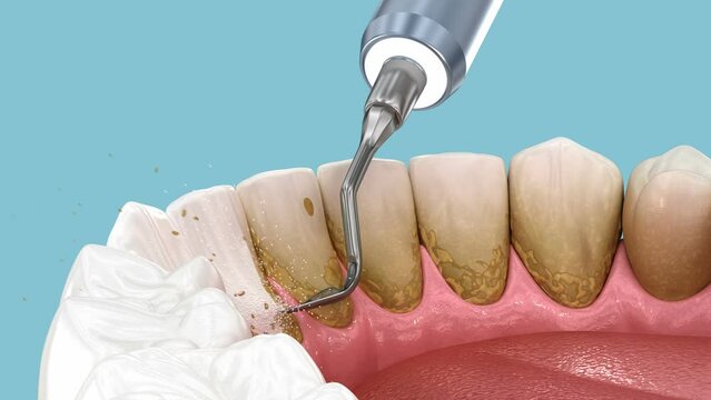 Teeth Cleaning Ultrasonic Scaling. Medically accurate 3D animation of human teeth treatment