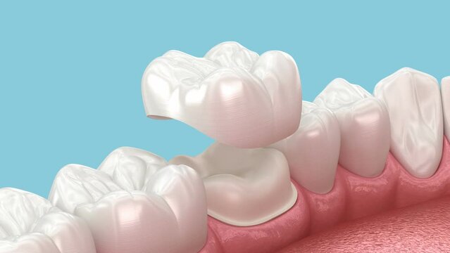 Preparated molar tooth and dental crown placement. Dental 3D animation