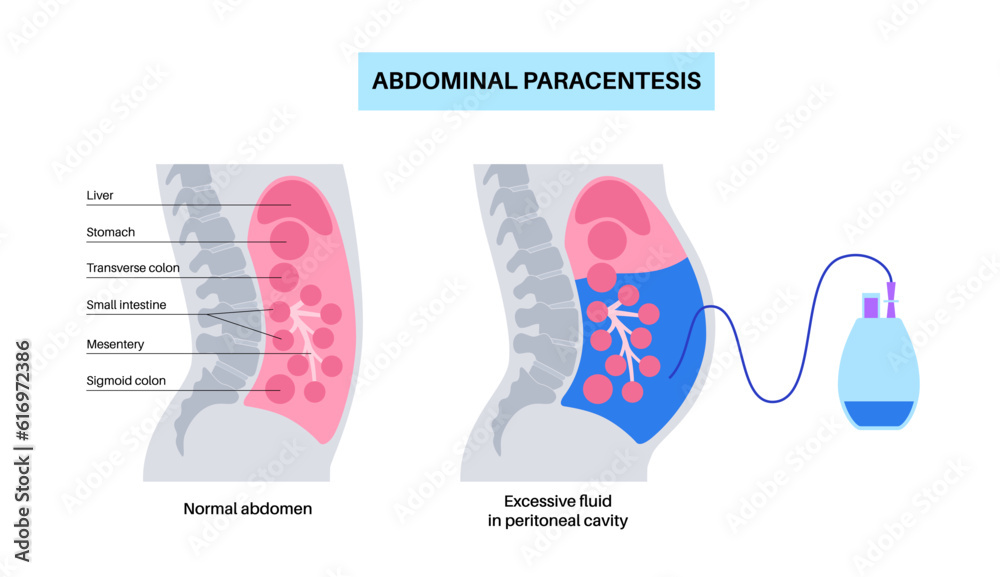 Wall mural Abdominal paracentesis poster