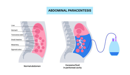 Abdominal paracentesis poster