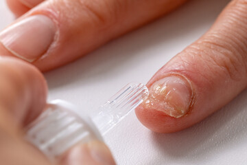 fungal nail infection treatment. applying amorolfine antifungal lacquer on hand fingernail