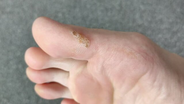 Large dry callus on the big toe
