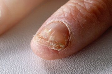 fungal infection. nail fungus candida on hand fingernail - obrazy, fototapety, plakaty