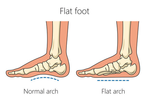 Flat feet bones schematic raster illustration. Medical science educational illustration