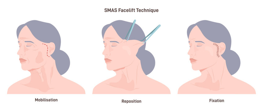 SMAS facelift surgery. Face features correction or anti-aging procedure