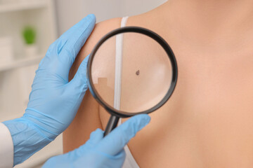 Dermatologist examining patient's birthmark with magnifying glass indoors, closeup - obrazy, fototapety, plakaty