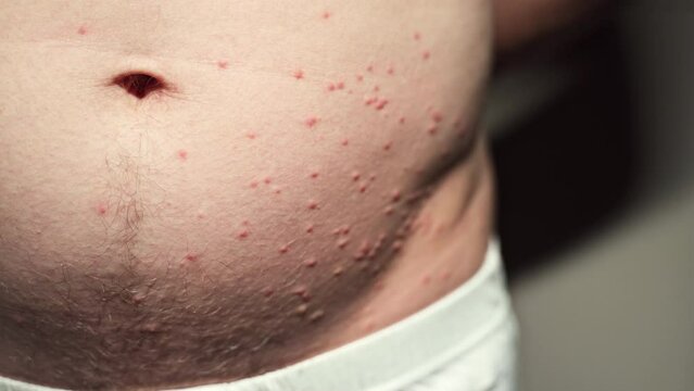 Pimples on the body, stomach. Possible insect bites, allergic reaction. Severe itching. Closeup of man's belly.