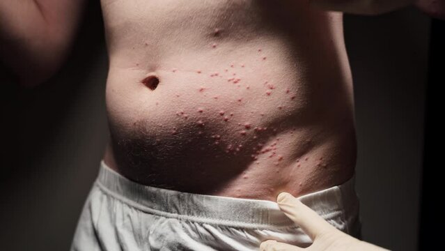 The man's stomach is covered in very itchy bumps caused by insect bites. An allergic reaction is also observed.